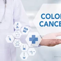 colon cancer causes, symptoms, and treatment