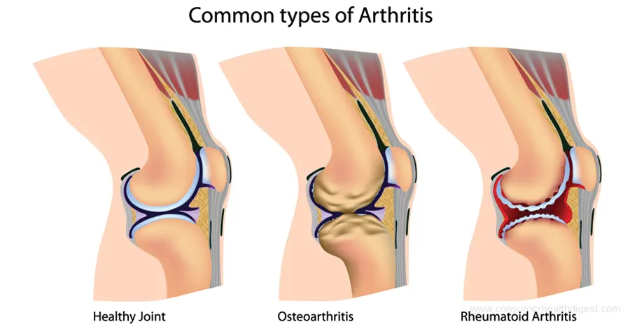 Common Types of Arthritis: Osteoarthritis, Rheumatoid Arthritis & More