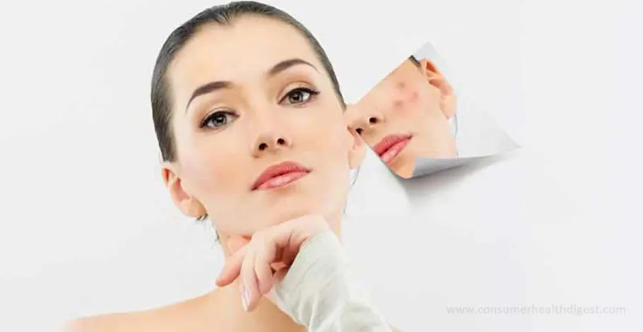 What Are The Symptoms & Treatment For Dark Spots On Face?