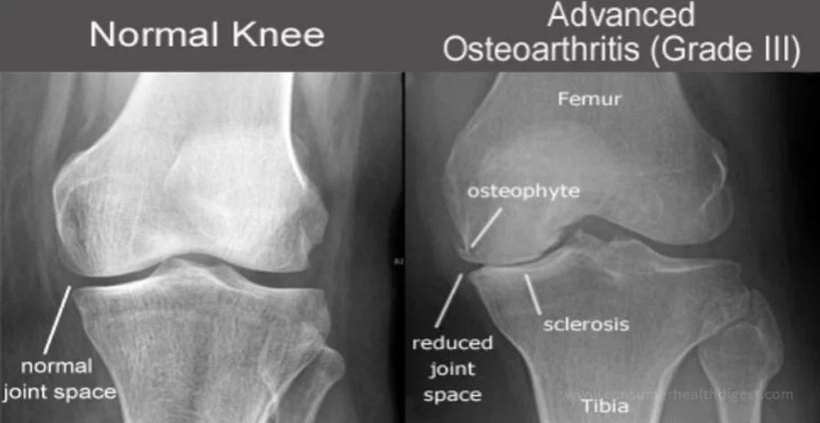 detect arthritis in an x ray