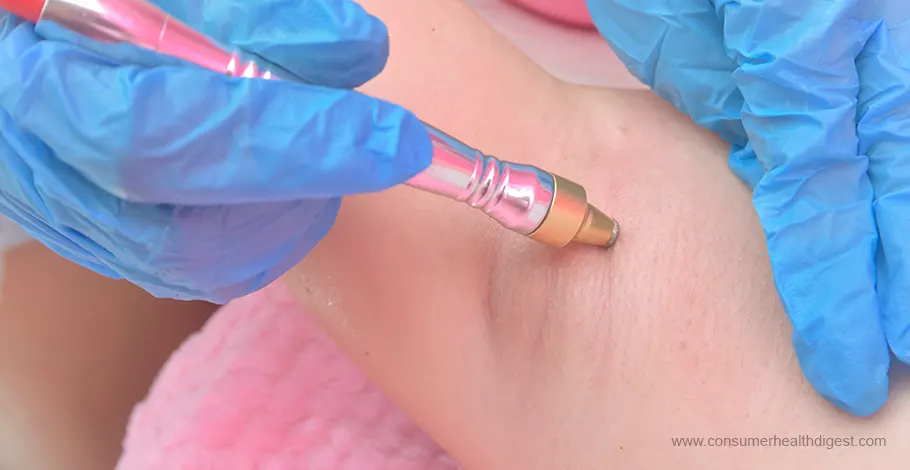 does microdermabrasion remove stretch marks?