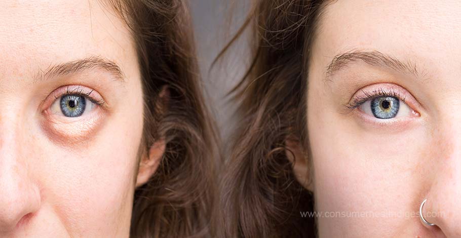 botox before and after eyes