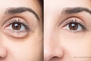 Understanding the Science Behind Under Eye Puffiness