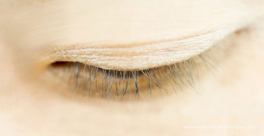 Treatment for Eyelash Mites