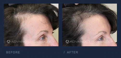 Foligrowth Before and After Women