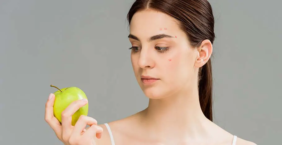 How Acne Is Related To The Food We Eat?