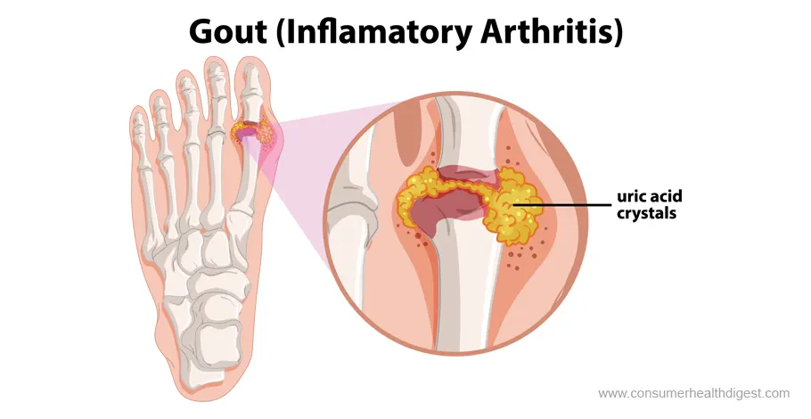 Gicht (entzündliche Arthritis)
