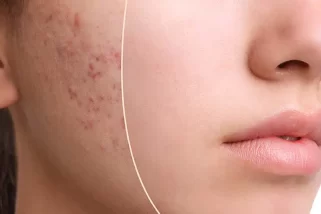 How to Get Rid of Acne – Treatments and Home Remedies
