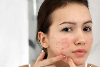 Everything You Need To Know About Acne