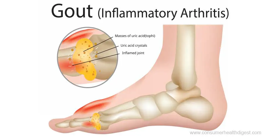 Artritis inflamatoria