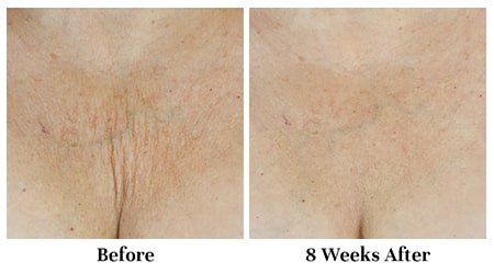 InvisiCrepe-Body-Balm-before-after