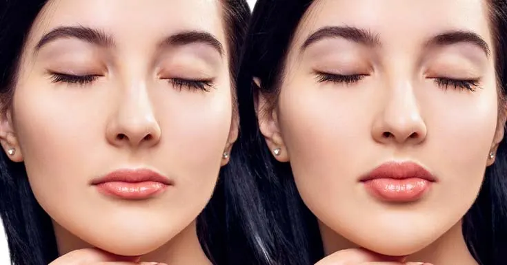 lip plumper before and after