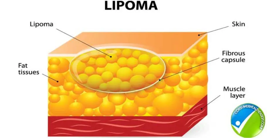Lipoma