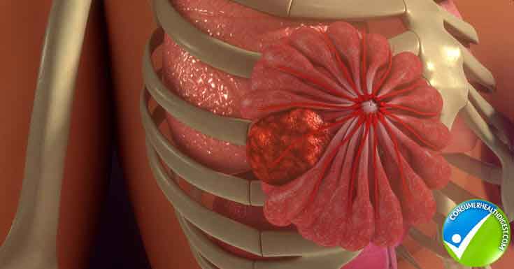 Metastatic Breast Cancer