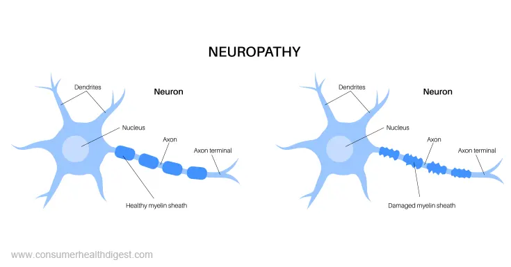neuropathy supplements