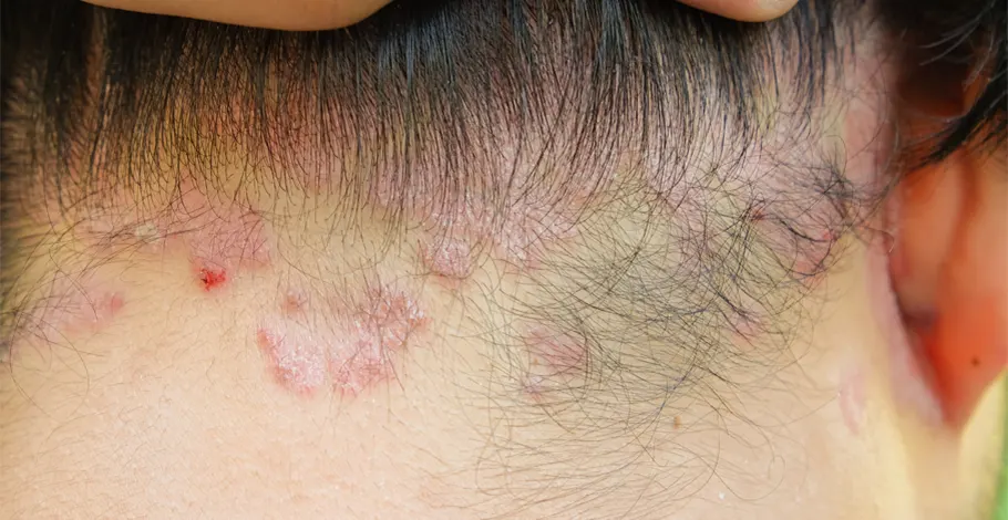 Plaque Psoriasis