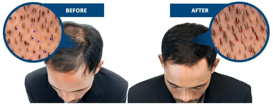 Profollica Before and After Result
