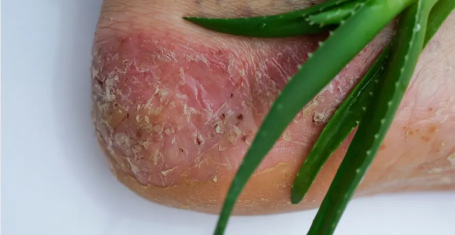 Pustular Psoriasis