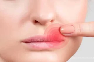 What Causes The Red Ring Around My Lips?