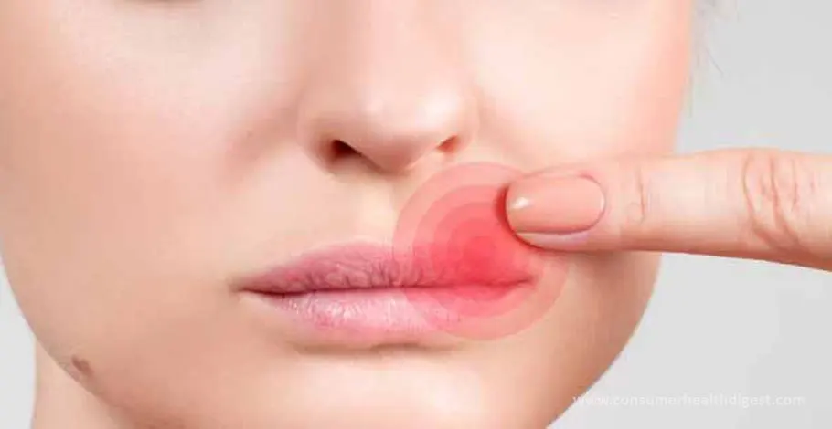 What Causes The Red Ring Around My Lips?