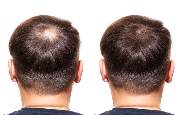 Regenix Before And After
