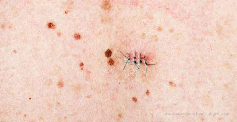 How to Get Rid of Skin Tags, Moles and Warts?