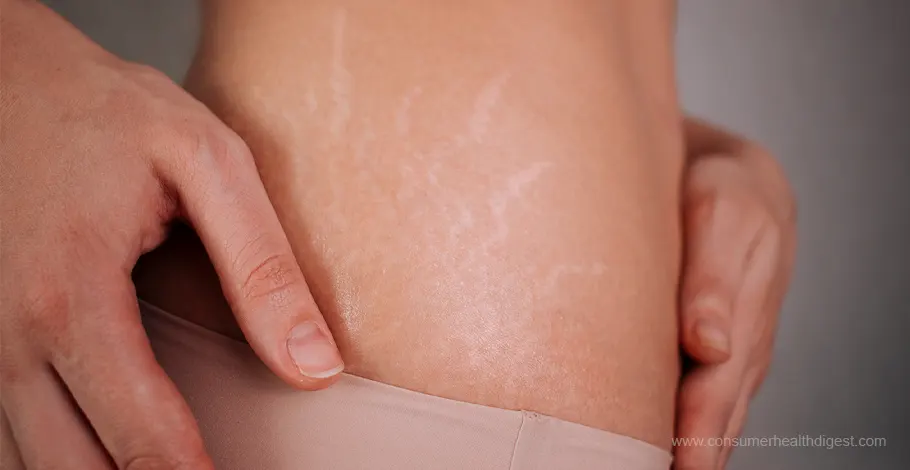 Stretch Marks Remedy