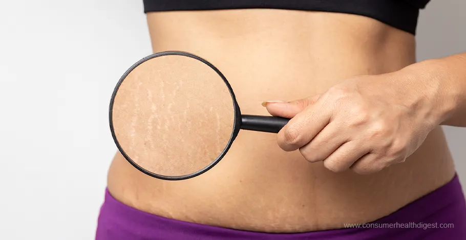 The Difference Between Red and White Stretch Marks