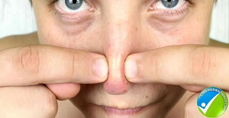 symptoms of blackheads