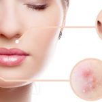 Top Rated Acne Products of 2021