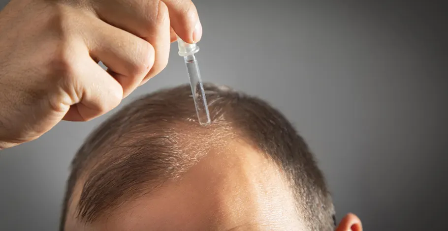 Topical minoxidil