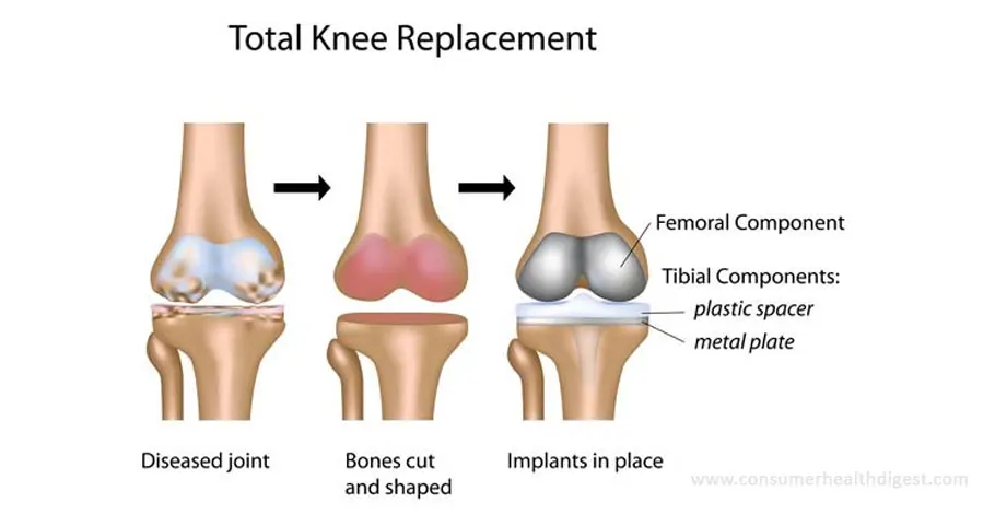 procedimiento de reemplazo total de rodilla