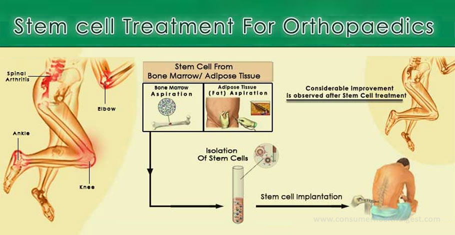 Stem Cell Treat