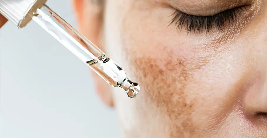 Treatment Options for Hyperpigmentation