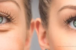 How to Remove Under Eye Bags – Diagnosis and Treatment