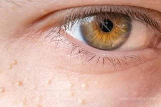 Augenmilben – Wie man Augenmilben loswird