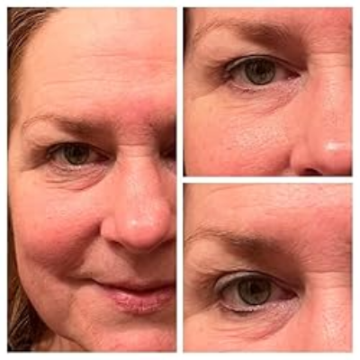 Vibriance Super C Serum Before and After Results