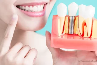 Restoring Smiles: What You Should Know About Dental Implants?
