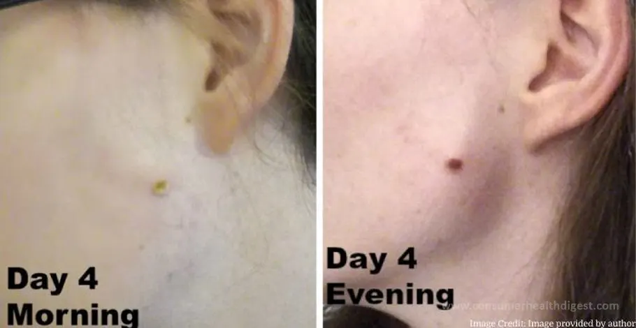 What Are Moles