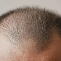 what is male pattern baldness