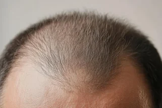 La calvitie masculine expliquée : causes, signes et traitements
